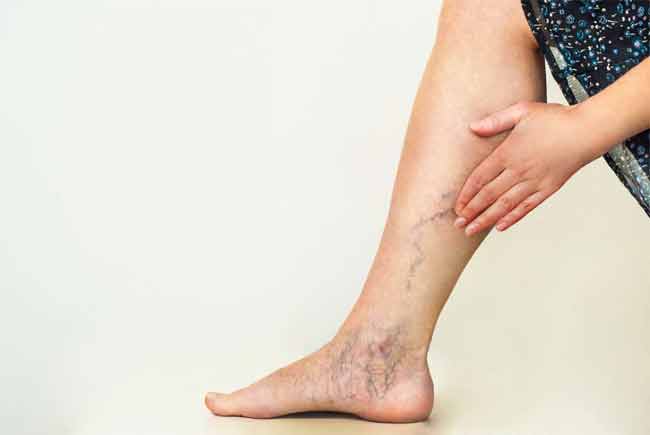 What are The Main Causes of Varicose Veins