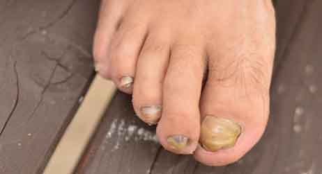 What Are The Symptoms Of Nail Fungus